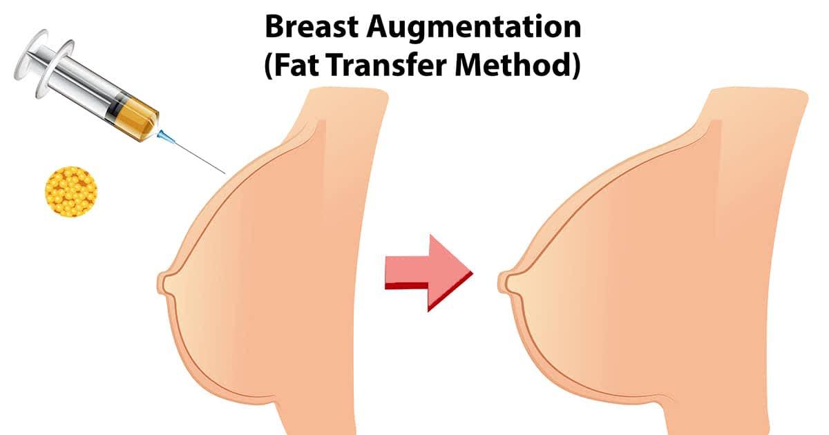 Fat Injection (Breast)